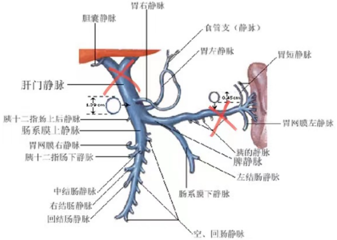 潍坊市中医院成功实施山东省首例经肠系膜上静脉肝外门体分流术