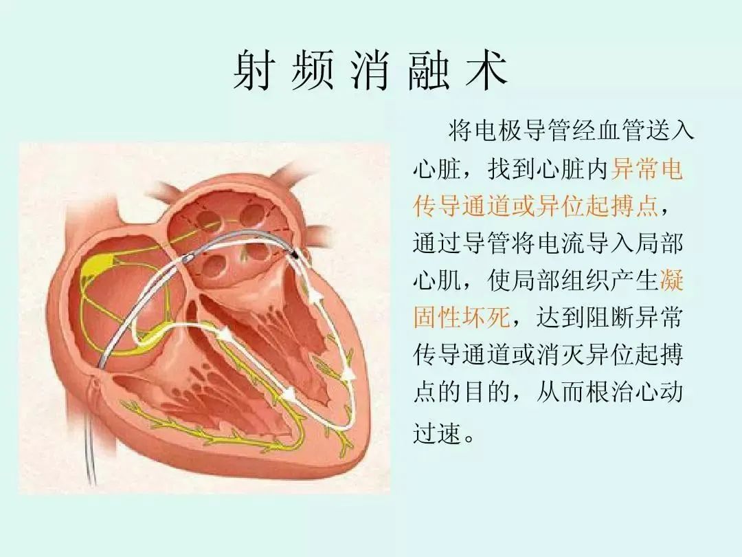 济阳区中医医院射频消融术:让患者"心慌"变"心安"