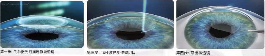 日照爱尔眼科小课堂：想做近视手术？先把这份“攻略”收好