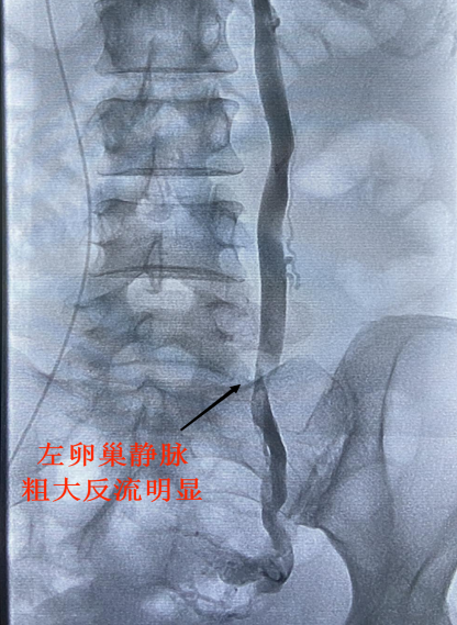 卵巢静脉粗如蚯蚓,女性"慢性盆腔痛"可以这样治疗-齐鲁晚报·齐鲁壹点