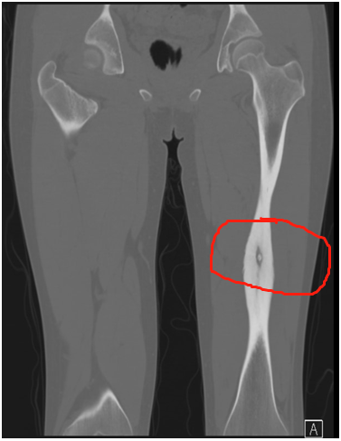 15岁男孩腿疼一年,原来是患上了这种病