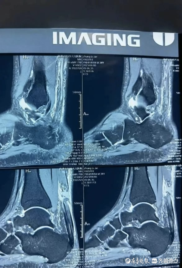 跟腱断裂磁共振图像图片