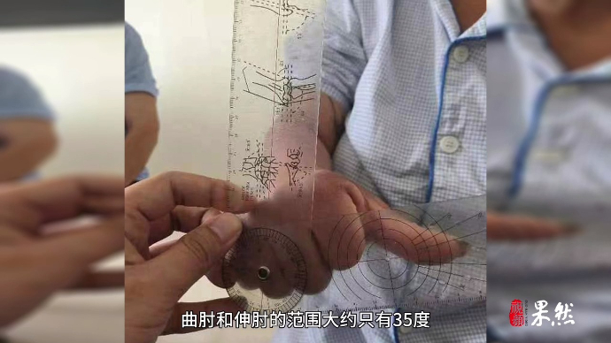 齐鲁医典·七院说|别扭了30年，她的手臂终于自由了