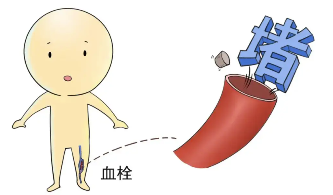 山东大学附属儿童医院血管瘤与介入血管外科医生张鑫介绍,静脉血栓是