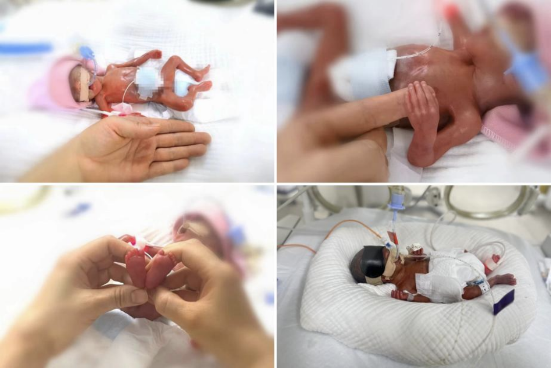 住院109天山东大学齐鲁医院430克超早早产宝宝顺利出院