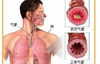 支气管扩张能否彻底治愈?