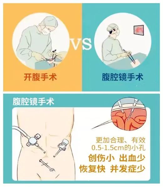 用微孔巧补穿孔日照港口医院成功完成腹腔镜下胃穿孔修补术