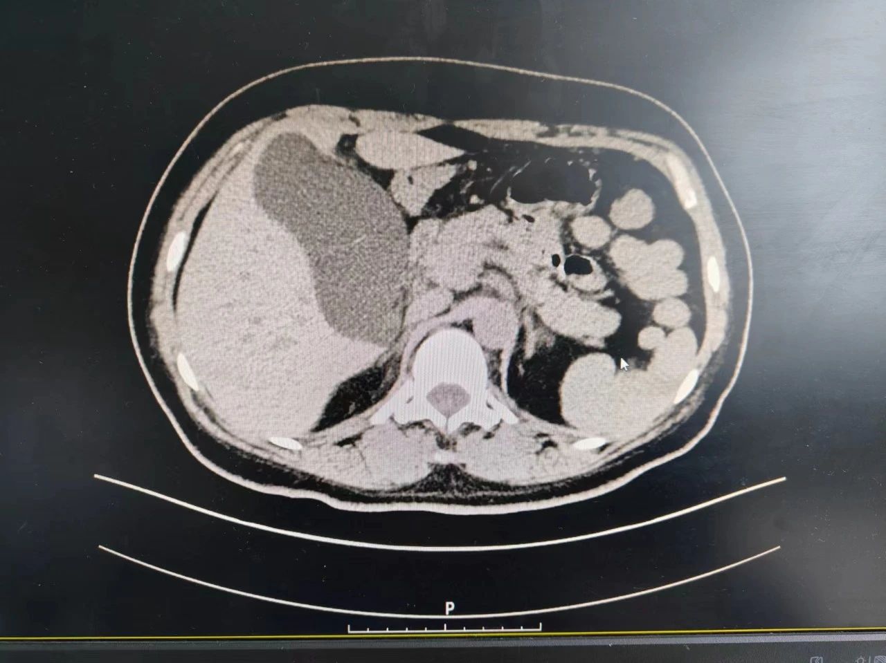 急性胆囊炎b超图片图片
