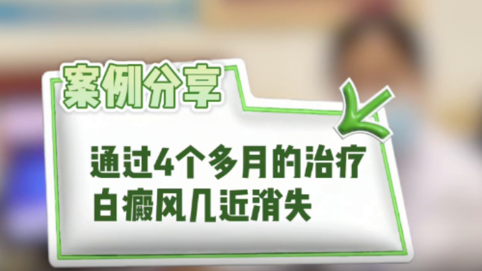 山东白癜风医院那个好？白癜风4个月治疗效果