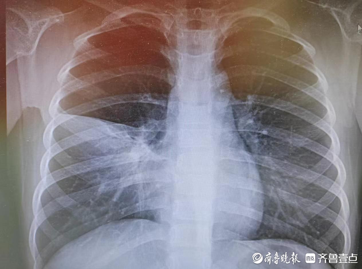 菏泽市创伤医院儿科专家针对支原体感染致大叶性肺炎开展早期诊疗