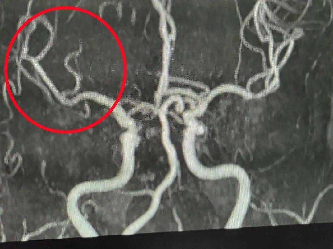 溶通前,红圈内为本次发生堵塞血管▲到达医院后,医生立即对老人进行了