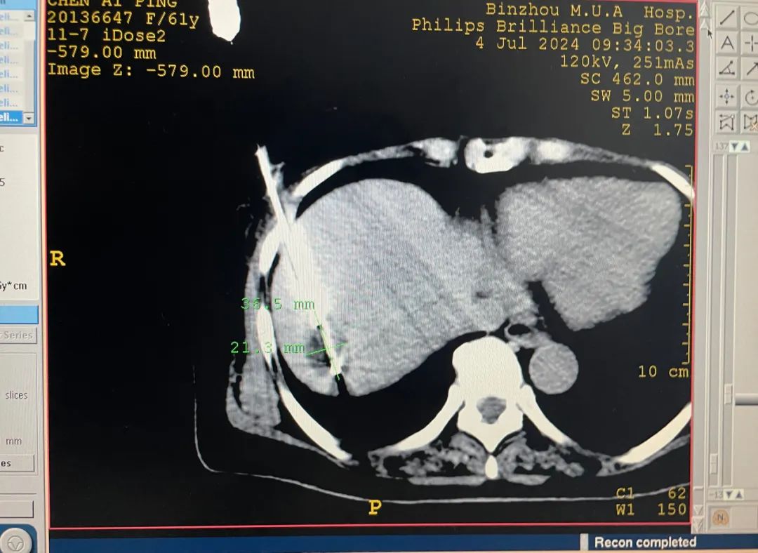 抗癌又添"新利器"!滨医附院多模态肿瘤治疗系统开启临床应用