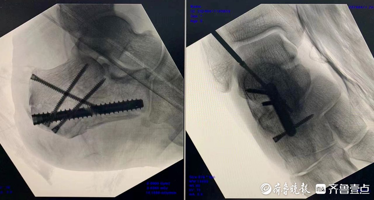 男子高处坠落致粉碎性骨折!"钉中钉"微创手术成功复位足跟