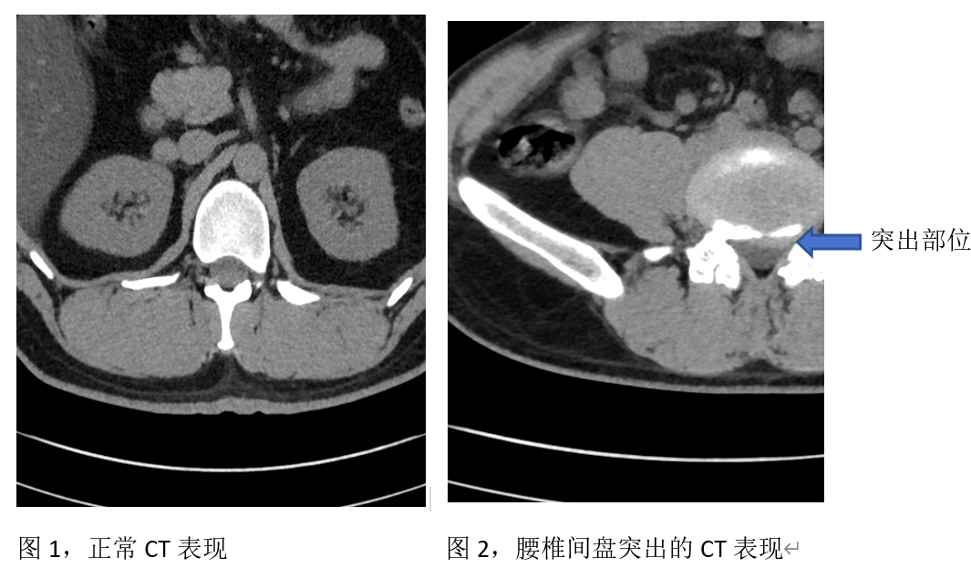 王禹增介绍,腰椎椎间盘连接上,下椎骨,由纤维环,软骨板和髓核组成