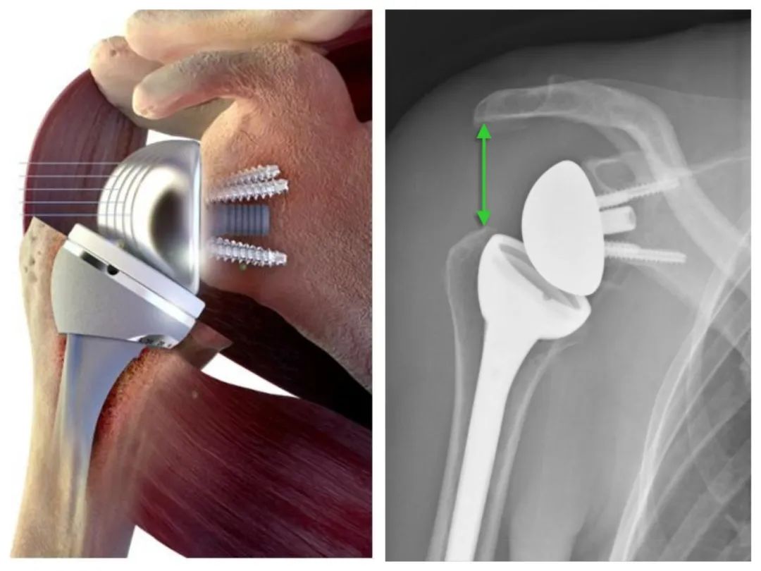 肱骨头置换术图片