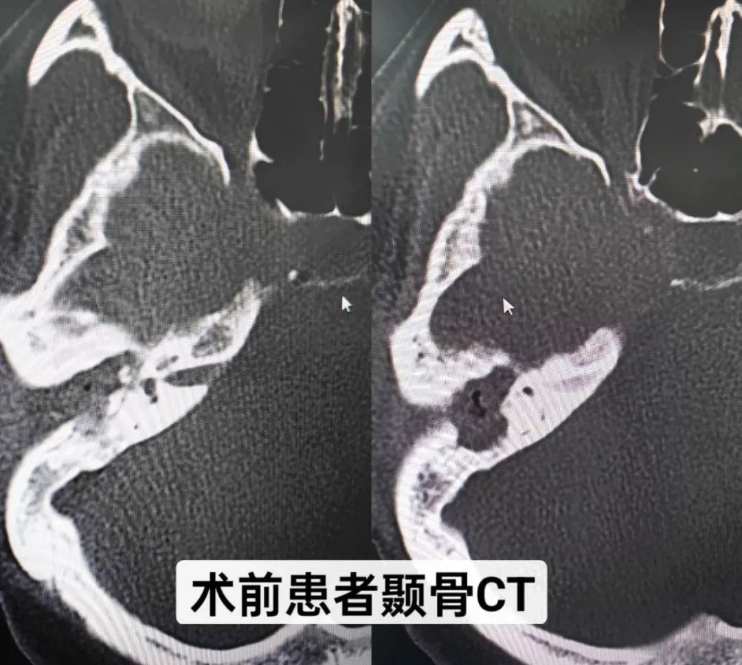 骨桥助听器植入图片