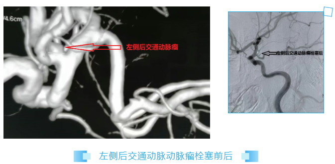 泰安市第一人民医院：微创“拆弹”，介入栓塞精准“封堵”颅内动脉瘤破口