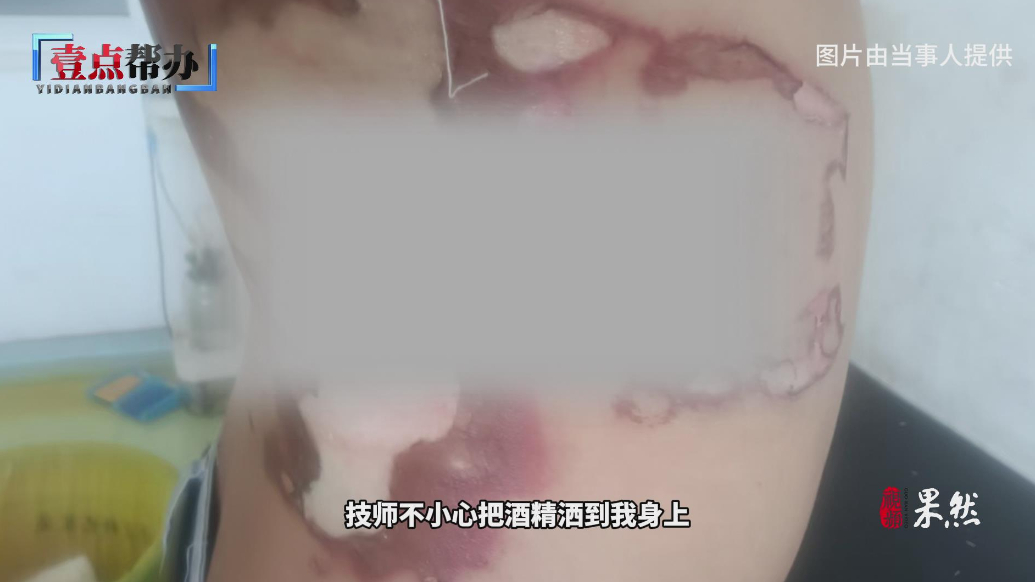 壹点帮办|青岛一足疗店操作失误致顾客烧伤，帮办介入后商家赔付