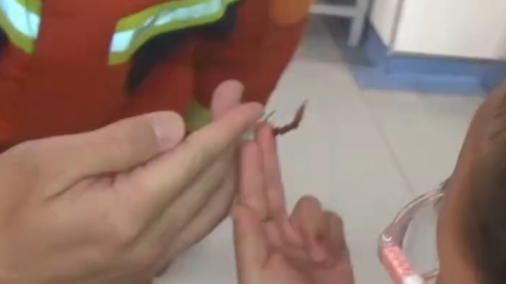 果然视频丨女童被鱼钩钩住手指，消防到医院剪钩救人