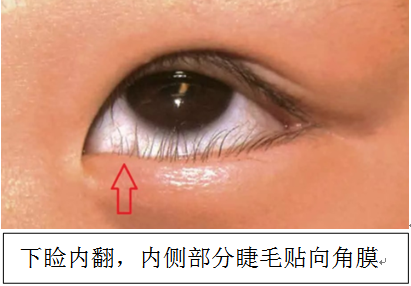 全国爱眼日|儿童先天性睑内翻：早发现早干预，守护孩子明亮双眸