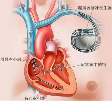 济南市中心医院成功实施可取出无导线起搏器植入手术