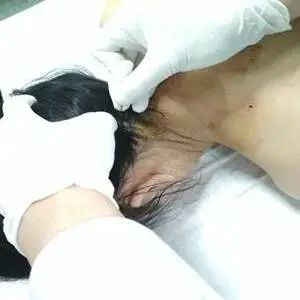 针刀结合龙氏正骨，告别眩晕困扰
