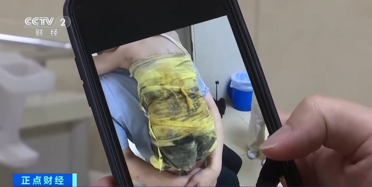 夏季高发儿童烫伤，处理不当或致严重感染