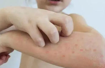 这3种皮肤病夏季高发 很多人痒到受不了！止痒攻略请查收