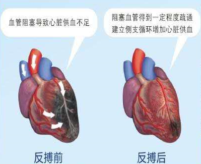 济南市三院：“躺赢”的心脏康复方案——体外反搏破解冠脉慢血流