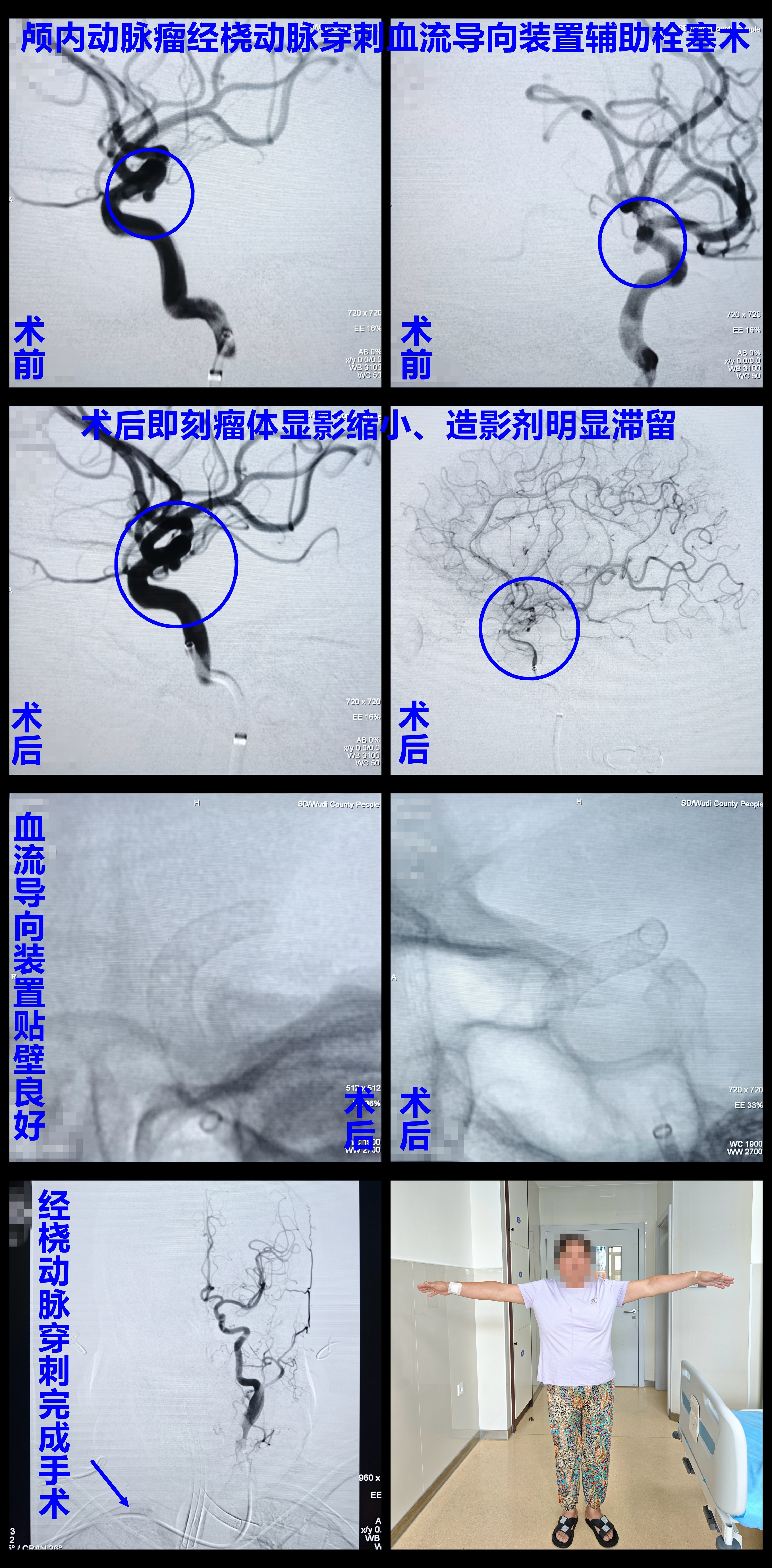 无棣县人民医院完成经桡动脉颅内动脉瘤血流导向装置辅助栓塞术