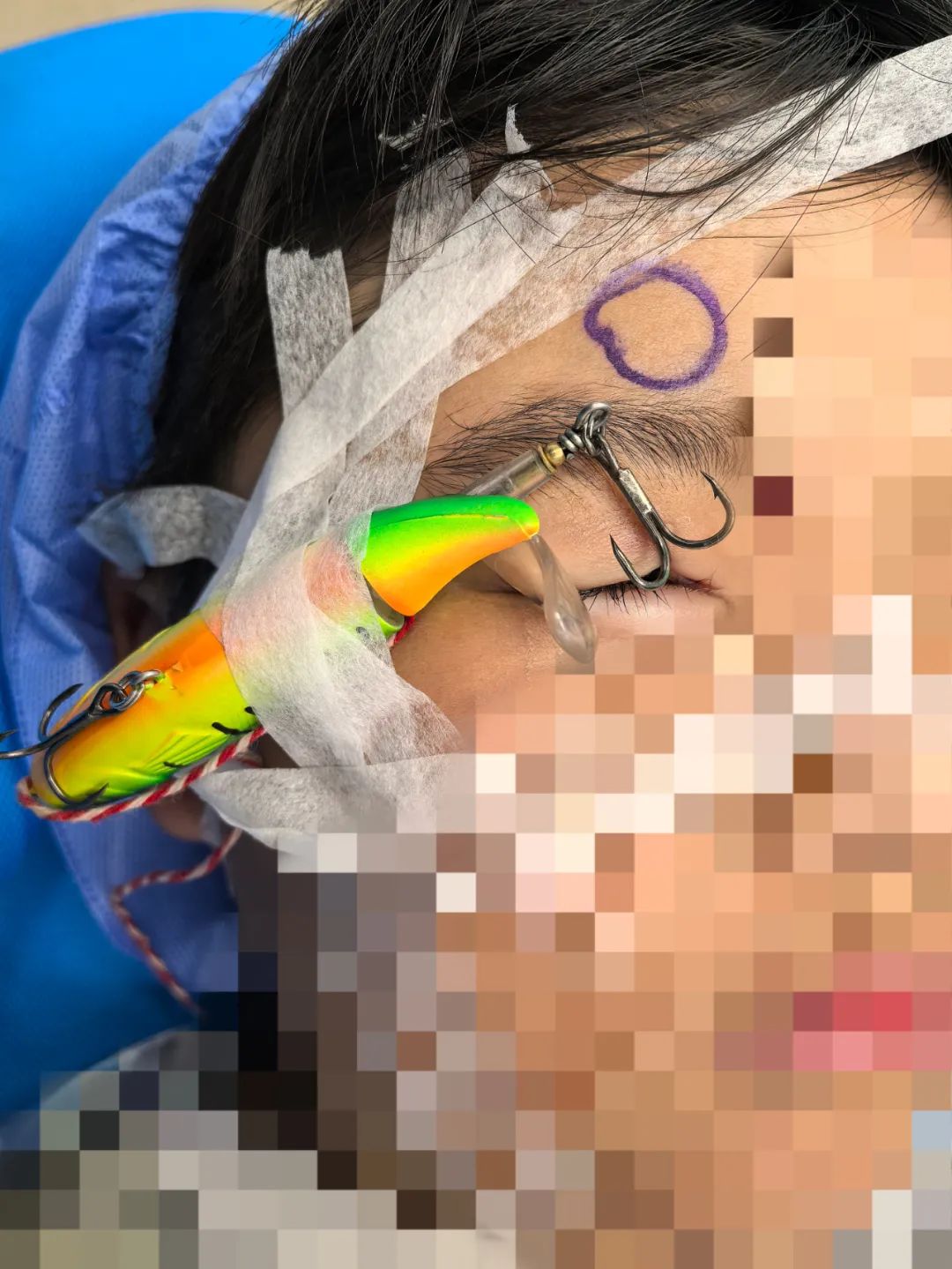 鱼钩刺穿眼球，济南市眼科医院成功解救八岁男孩