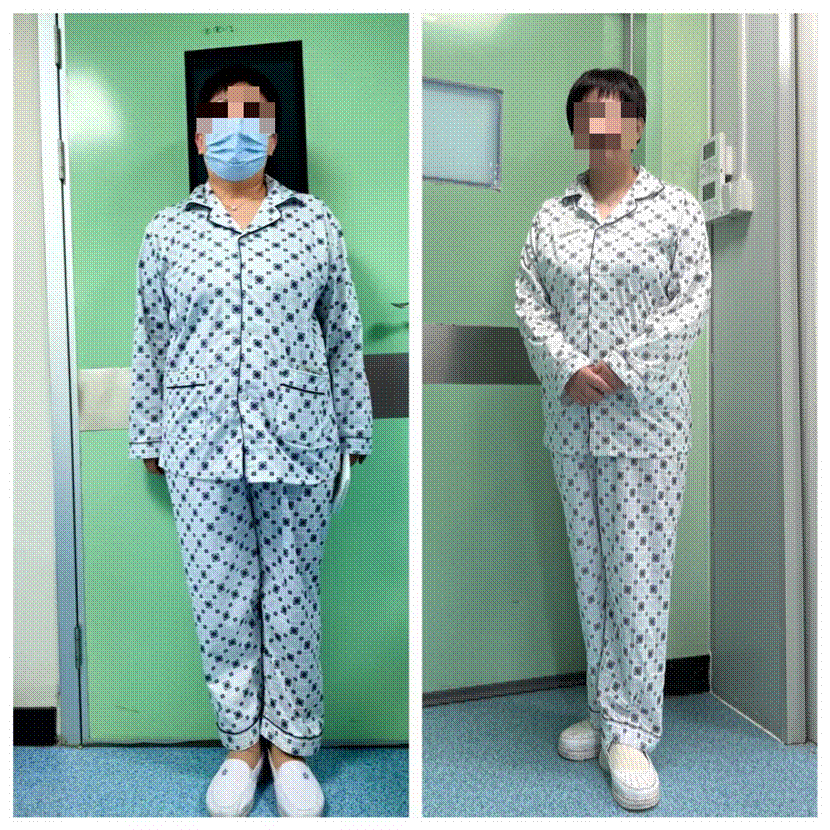 3个月减重26斤！山东省第二人民医院成功实施胃转流支架置入术