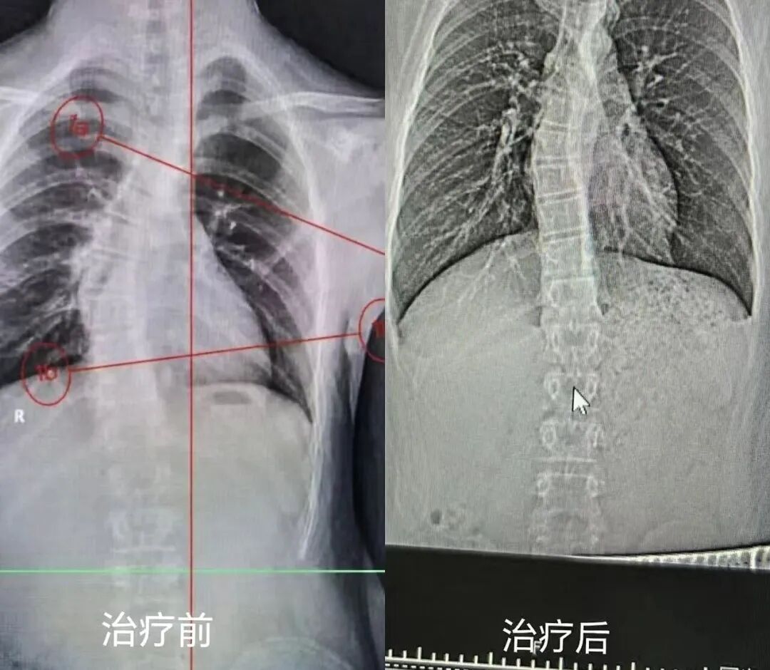 滕州中心人民医院康复医学科脊柱侧弯患者干预与疗效工作初见成效