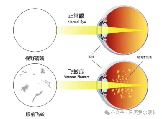 日照爱尔眼科小课堂丨为什么眼前的“蚊子”挥之不去 ?