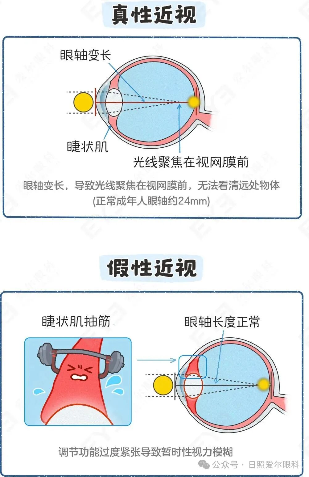 日照爱尔眼科小课堂丨孩子近视50度，要马上配眼镜吗？