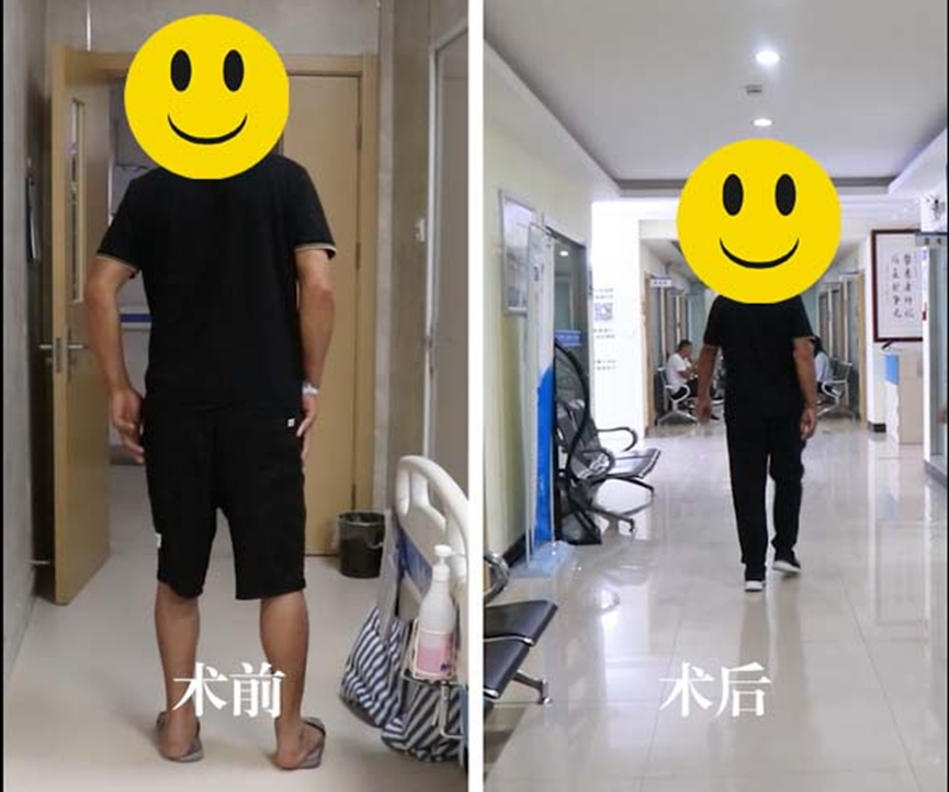 双侧股骨头坏死，术后20天脱拐如愿回归正常生活