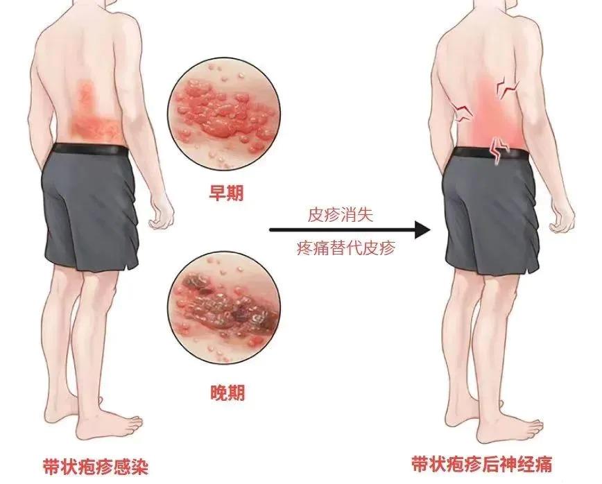 “最疼皮肤病”进入高发期，出现这些疼痛信号别大意
