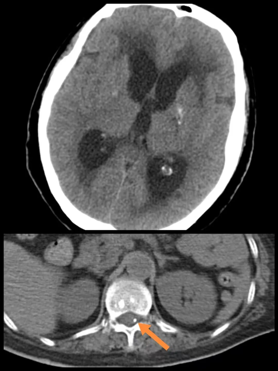 给大脑“减压”！滨州市中心医院成功完成腰大池腹腔分流术