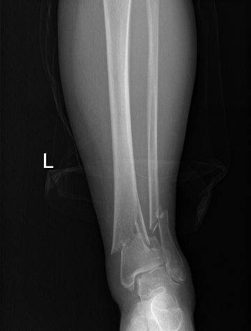 滨州市中心医院完成首例DTN胫骨远端髓内钉固定手术