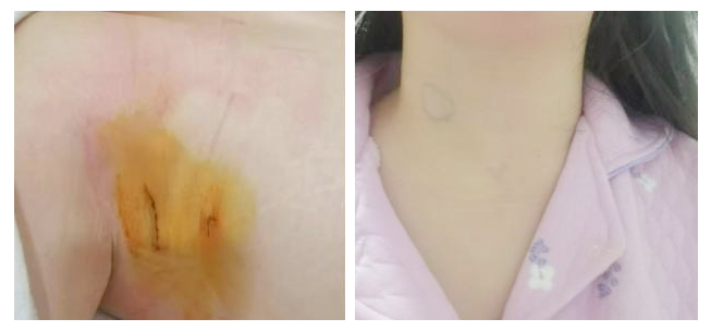 “我还年轻不想留疤！”年轻女性患甲状腺癌，两难困境如何破解？