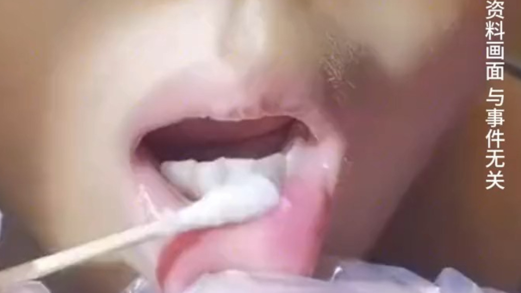 36岁男子反复口腔溃疡20年以为是上火，确诊白塞病后自行停药致右眼失明