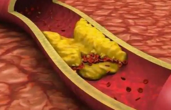 血管钙化是补钙闹的？