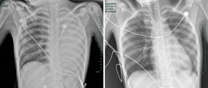 发热仅1天，12岁初中女生肺全白！专家：极度危险，千万别当普通感冒！