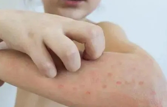 一换季皮肤就干红痒“闹情绪”？医生支招精准应对