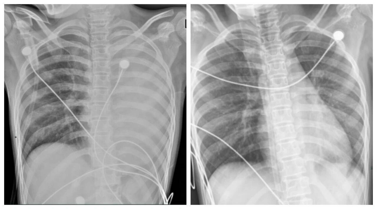 发热1天左肺全白！这种病可堵塞气道，别误当普通感冒