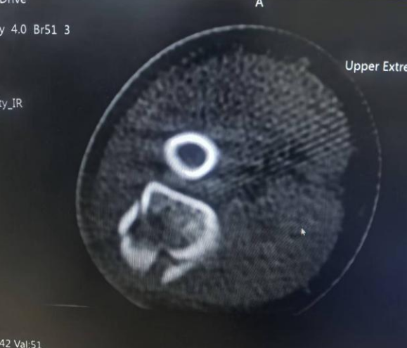 滨州市中医医院骨伤科（创伤）不开刀治骨折