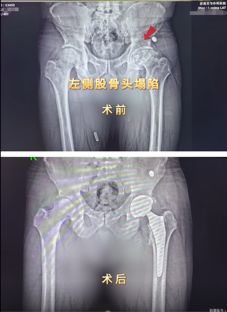 济南关节外科医院妙手除疾，帮滨州股骨头坏死大哥找回健康生活