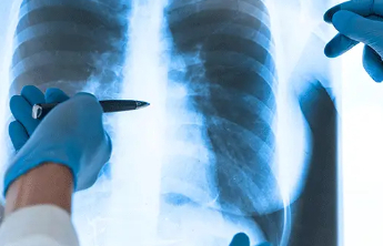 检出肺结节 不必成心结