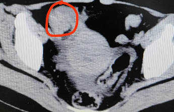 正大量上市！女子一口气吃3个，痛到进医院，医生提醒