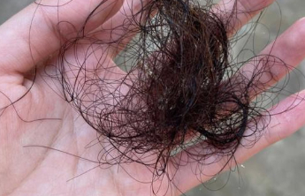 秋冬季掉发增多是病吗？专家教你区分生理性和病理性脱发